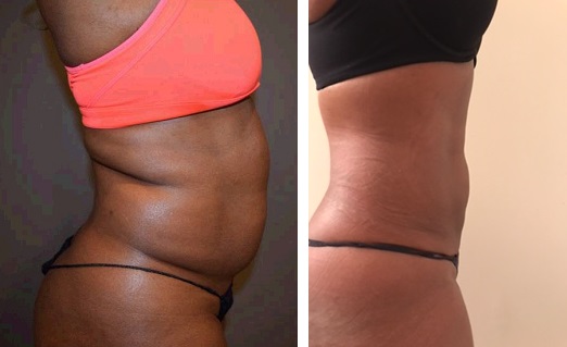 female photo before and after liposuction