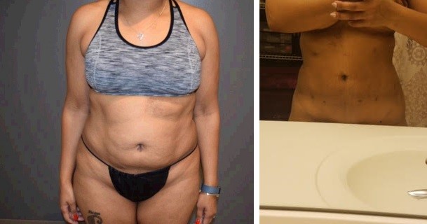 patient before and after liposuction 