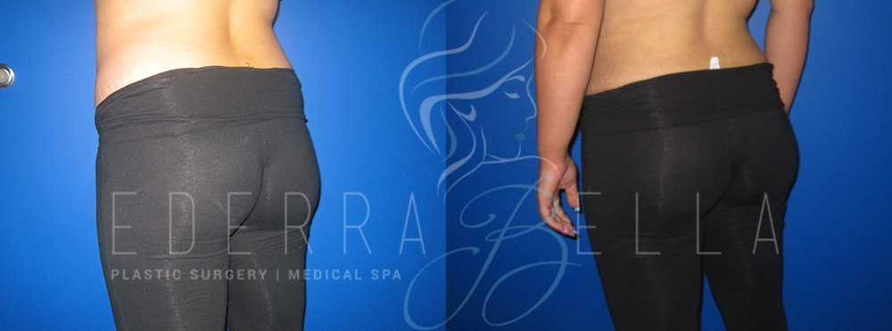 Augmentation Fat Transfer before and after