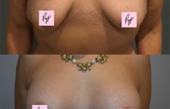Breast Augmentation before and after