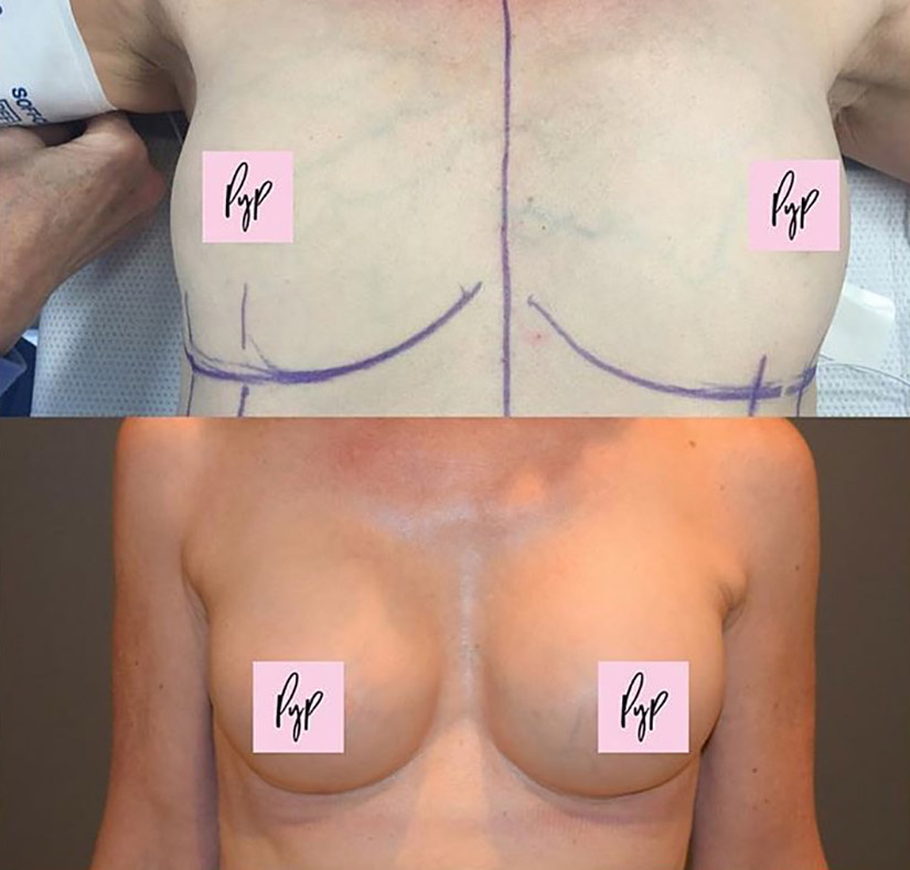 Breast Augmentation before and after