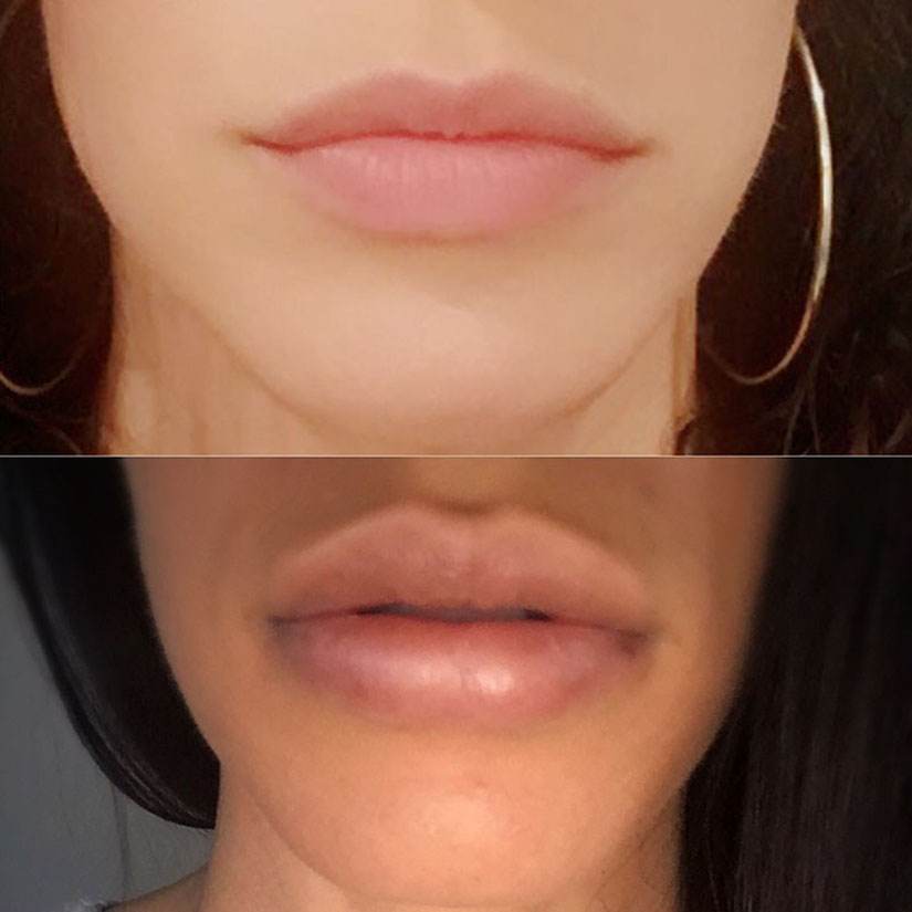 Lip Filler before and after